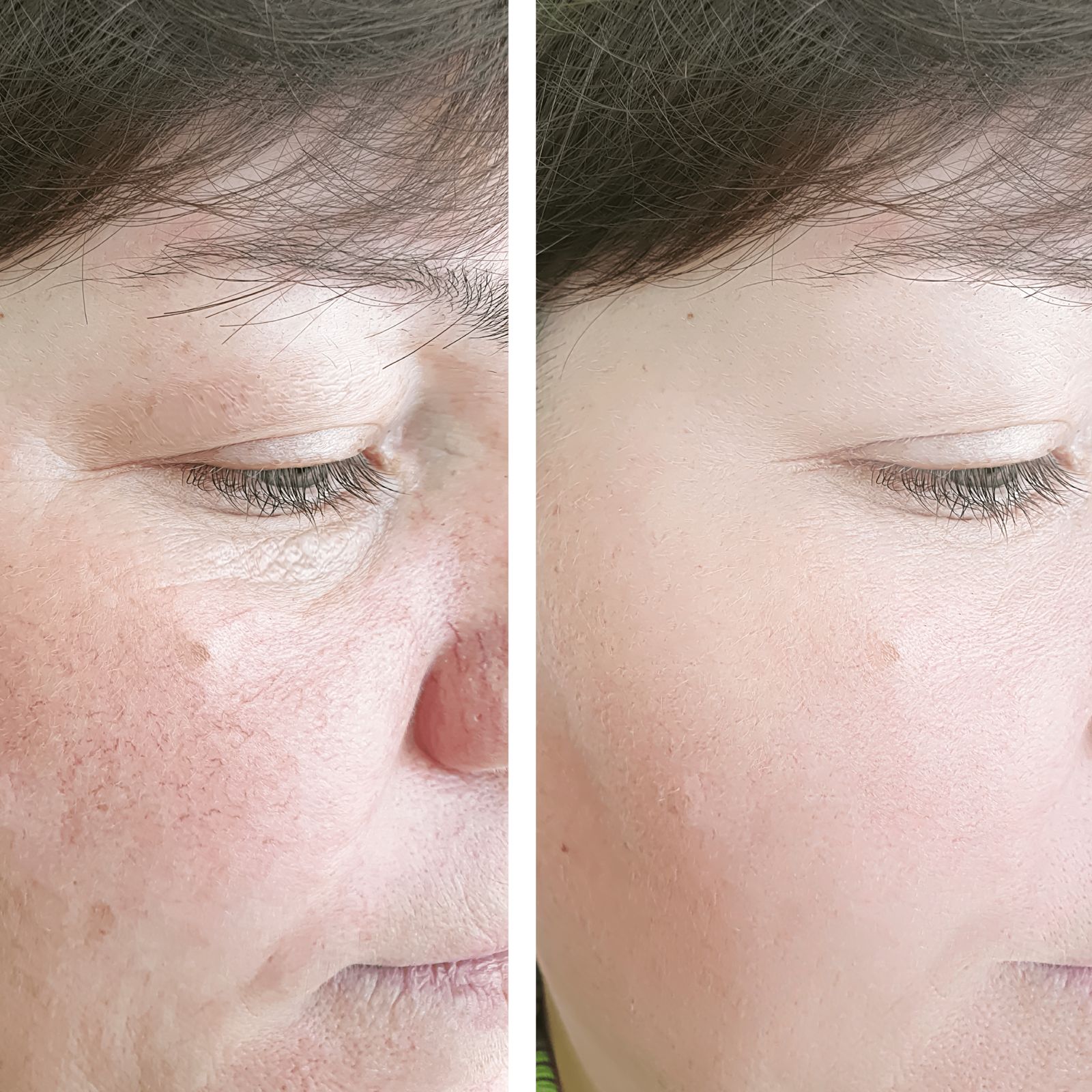 Combo RenovaPiel 360